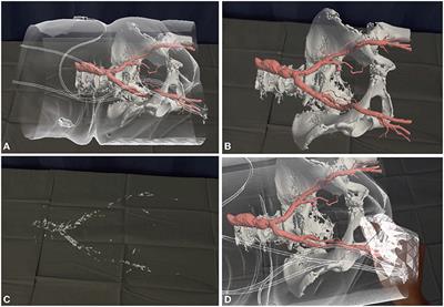 Editorial: Transcatheter Aortic Valve Implantation: All Transfemoral? Update on Vascular Acccess and Closure